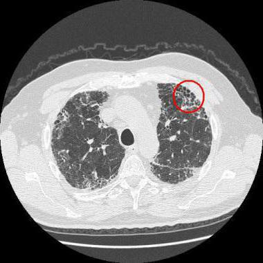 Lungehemosiderose: manifestasjon og behandling